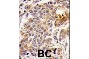 Formalin-fixed and paraffin-embedded human breast carcinoma tissue reacted with PRKp, which was peroxidase-conjugated to the secondary antibody, followed by DAB staining. (AMPK alpha Antikörper  (AA 474-502))