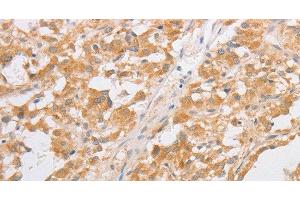 Immunohistochemistry of paraffin-embedded Human thyroid cancer tissue using CDKN2AIP Polyclonal Antibody at dilution 1:40 (CDKN2AIP Antikörper)