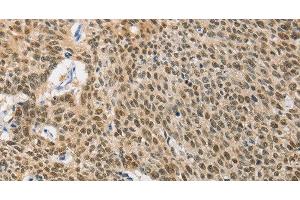 Immunohistochemistry of paraffin-embedded Human lung cancer using HSP40 Polyclonal Antibody at dilution of 1:40 (DNAJB1 Antikörper)