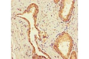 Immunohistochemistry of paraffin-embedded human prostate cancer using ABIN7174476 at dilution of 1:100 (UBE2Q2 Antikörper  (AA 1-375))