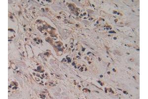 IHC-P analysis of CHuman Breast Cancer Tissue, with DAB staining.