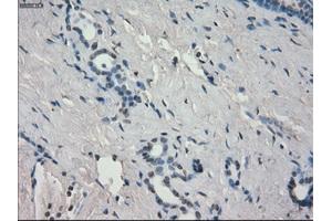 Immunohistochemical staining of paraffin-embedded Adenocarcinoma of breast tissue using anti-AURKC mouse monoclonal antibody. (Aurora Kinase C Antikörper)