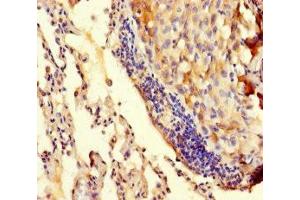 Immunohistochemistry of paraffin-embedded human lung cancer using ABIN7173512 at dilution of 1:100 (TRMT112 Antikörper  (AA 1-125))