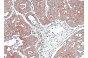 IHC-P Image Immunohistochemical analysis of paraffin-embedded Gastric CA N87 xenograft, using MPI, antibody at 1:100 dilution. (MPI Antikörper)