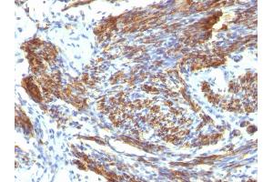 Formalin-fixed, paraffin-embedded human Leiomyosarcoma stained with Caldesmon Mouse Monoclonal Antibody (CALD1/820). (Caldesmon Antikörper)