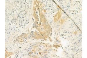 ABIN6261506 and ABIN6272997 at 1/100 staining human lung squamous cell carcinoma by IHC-P. (ELAC2 Antikörper  (N-Term))