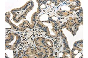 The image on the left is immunohistochemistry of paraffin-embedded Human thyroid cancer tissue using ABIN7193040(WDR36 Antibody) at dilution 1/35, on the right is treated with synthetic peptide. (WDR36 Antikörper)