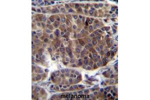 PRAMEF3 Antibody (C-term) immunohistochemistry analysis in formalin fixed and paraffin embedded human melanoma followed by peroxidase conjugation of the secondary antibody and DAB staining. (PRAMEF3 Antikörper  (C-Term))