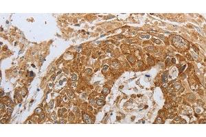 Immunohistochemistry of paraffin-embedded Human esophagus cancer using CKM Polyclonal Antibody at dilution of 1:50 (CKM Antikörper)