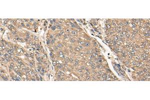 Immunohistochemistry of paraffin-embedded Human liver cancer tissue using C17orf67 Polyclonal Antibody at dilution of 1:50(x200) (C17ORF67 Antikörper)