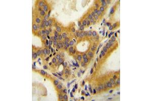 CC85C Antibody (N-term) (ABIN654469 and ABIN2844203) immunohistochemistry analysis in formalin fixed and paraffin embedded human prostate carcinoma followed by peroxidase conjugation of the secondary antibody and DAB staining. (CCDC85C Antikörper  (N-Term))