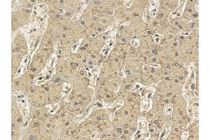 SLC47A2 Mouse Monoclonal Antibody at 1/100 staining human liver cancer and adjacent non-tumor tissue by IHC-P. (SLC47A2 Antikörper)