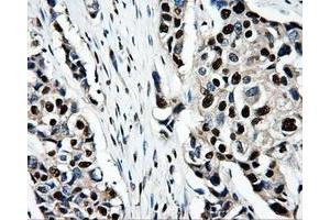 Immunohistochemical staining of paraffin-embedded Adenocarcinoma of ovary tissue using anti-PSMC3mouse monoclonal antibody. (PSMC3 Antikörper)