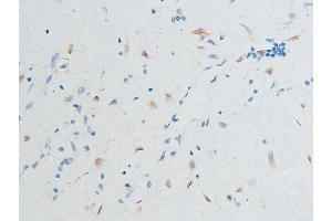 ABIN6267252 at 1/100 staining human glioma tissue sections by IHC-P.