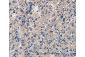 Immunohistochemistry of Human liver cancer using IMPDH1 Polyclonal Antibody at dilution of 1:20 (IMPDH1 Antikörper)
