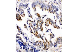 Anti-Beta Arrestin 2 antibody, IHC(P) IHC(P): Human Intestinal Cancer Tissue