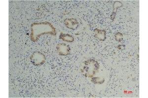 Immunohistochemistry (IHC) analysis of paraffin-embedded Human Pancreatic Carcinoma using Cyclophilin B Mouse Monoclonal Antibody diluted at 1:200. (PPIB Antikörper)