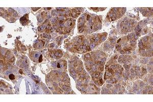 ABIN6273395 at 1/100 staining Human liver cancer tissue by IHC-P. (SCN3A Antikörper  (Internal Region))