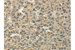 The image on the left is immunohistochemistry of paraffin-embedded Human liver cancer tissue using ABIN7128060(UBL4B Antibody) at dilution 1/25, on the right is treated with fusion protein. (UBL4B Antikörper)