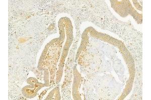 ABIN6264693 and ABIN6279754 at 1/100 staining human colon carcinoma by IHC-P. (Reelin Antikörper  (N-Term))