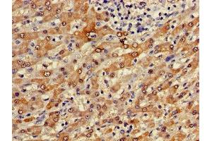 Immunohistochemistry of paraffin-embedded human liver cancer using ABIN7153223 at dilution of 1:100 (FUOM Antikörper  (AA 1-134))