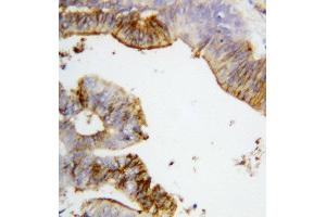 Anti-Annexin A2 antibody, IHC(P) IHC(P): Human Intestinal Cancer Tissue (Annexin A2 Antikörper  (Middle Region))