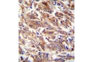 Immunohistochemistry analysis in formalin fixed and paraffin embedded human breast carcinoma reacted with FBXW12 Antibody (C-term) followed by peroxidase conjugation of the secondary antibody and DAB staining. (FBXW12 Antikörper  (C-Term))
