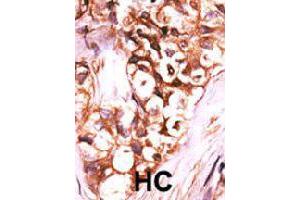 Formalin-fixed and paraffin-embedded human hepatocellular carcinoma tissue reacted with DUSP8 polyclonal antibody  , which was peroxidase-conjugated to the secondary antibody, followed by AEC staining. (DUSP8 Antikörper  (C-Term))
