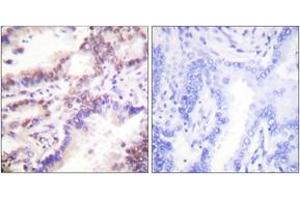 Immunohistochemistry analysis of paraffin-embedded human lung carcinoma tissue, using CTIP (Ab-327) Antibody. (Retinoblastoma Binding Protein 8 Antikörper  (AA 293-342))