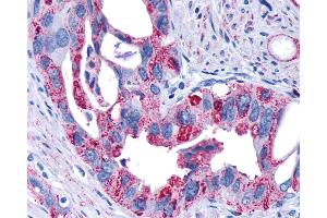 Anti-FZD4 / Frizzled 4 antibody IHC of human Pancreas, Carcinoma. (FZD4 Antikörper  (N-Term))