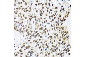 Immunohistochemistry of paraffin-embedded human lung cancer using FUBP1 antibody (ABIN5973257) at dilution of 1/100 (40x lens). (FUBP1 Antikörper)