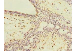 Immunohistochemistry of paraffin-embedded human breast cancer using ABIN7168420 at dilution of 1:100 (ROPN1L Antikörper  (AA 1-230))