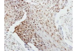 IHC-P Image Immunohistochemical analysis of paraffin-embedded human breast cancer, using Bcl-2, antibody at 1:250 dilution.