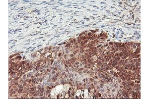 Immunohistochemical staining of paraffin-embedded Adenocarcinoma of Human ovary tissue using anti-NLN mouse monoclonal antibody. (NLN Antikörper)