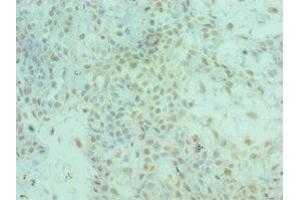 Immunohistochemistry of paraffin-embedded human breast cancer using ABIN7143956 at dilution of 1:100 (ALS2 Antikörper  (AA 1-280))