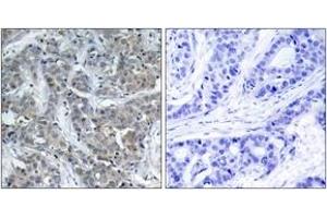 Immunohistochemistry analysis of paraffin-embedded human breast carcinoma tissue, using Stathmin 1 (Ab-15) Antibody. (Stathmin 1 Antikörper  (AA 5-54))