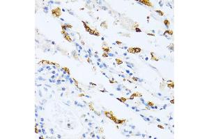 Immunohistochemistry of paraffin-embedded human lung cancer using SFTPC antibody. (Surfactant Protein C Antikörper)