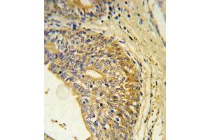 EDNRB Antibody (C-term) (ABIN390760 and ABIN2841017) immunohistochemistry analysis in formalin fixed and paraffin embedded human prostate carcinoma followed by peroxidase conjugation of the secondary antibody and DAB staining. (EDNRB Antikörper  (C-Term))