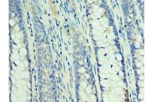 Immunohistochemistry of paraffin-embedded human colon cancer using ABIN7160232 at dilution of 1:100 (SMAD3 Antikörper  (AA 1-230))