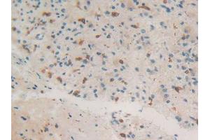 IHC-P analysis of Human Glioma Tissue, with DAB staining. (Coronin 1a Antikörper  (AA 7-204))