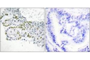Immunohistochemistry analysis of paraffin-embedded human lung carcinoma, using PKC delta (Phospho-Tyr52) Antibody. (PKC delta Antikörper  (pTyr52))