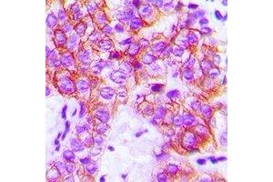 Immunohistochemical analysis of Focal Adhesion Kinase staining in human breast cancer formalin fixed paraffin embedded tissue section. (FAK Antikörper  (C-Term))