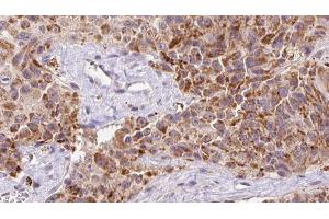 ABIN6273147 at 1/100 staining Human Melanoma tissue by IHC-P. (Osteocalcin Antikörper  (Internal Region))