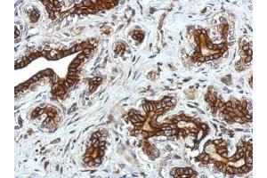 IHC-P Image Immunohistochemical analysis of paraffin-embedded human breast cancer, using Glycine Receptor alpha 2, antibody at 1:750 dilution. (GLRa2 Antikörper)