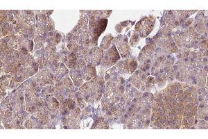 ABIN6273276 at 1/100 staining Human pancreas cancer tissue by IHC-P.