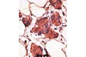 Formalin-fixed and paraffin-embedded human cancer tissue reacted with the primary antibody, which was peroxidase-conjugated to the secondary antibody, followed by AEC staining. (MAGEA9 Antikörper  (AA 171-198))