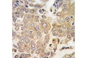 IHC analysis of FFPE human lung carcinoma tissue stained with MAPK4 antibody (MAPK4 Antikörper  (AA 72-101))