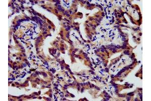 IHC image of ABIN7165980 diluted at 1:400 and staining in paraffin-embedded human lung cancer performed on a Leica BondTM system. (SSH3 Antikörper  (AA 480-659))
