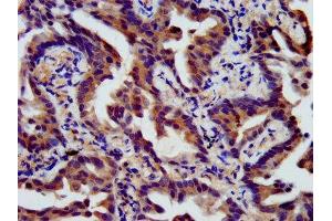 IHC image of ABIN7165980 diluted at 1:400 and staining in paraffin-embedded human lung cancer performed on a Leica BondTM system.