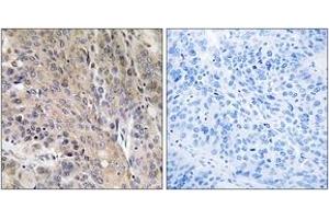 Immunohistochemistry analysis of paraffin-embedded human lung carcinoma, using LAMP3 Antibody. (LAMP3 Antikörper  (AA 274-323))